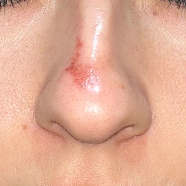 Burun Bölgesinde Şiddetli Cilt Bakımı Sonrası Deri Soyulması Ve Merkezden Açıklama Bekleniyor