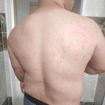 Epify Tüy Dökücü Kremden Şiddetli Sivilcelenme Ve Cilt Hasarı