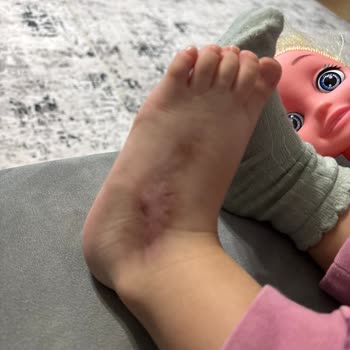 Medipol Sağlık Grubu Çocuğumun Ayağındaki Kalıcı Zarar Ve Hastane İhmali
