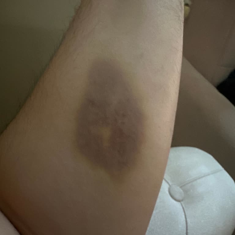 Acil Serviste Dikkatsiz Serum Çıkarma İşlemi Ve Kol Morarması