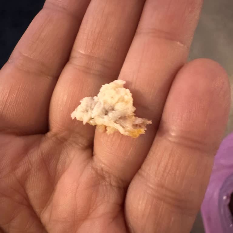 Burger King Çocuk Menüsünde Kemik Parçası Tehlikesi