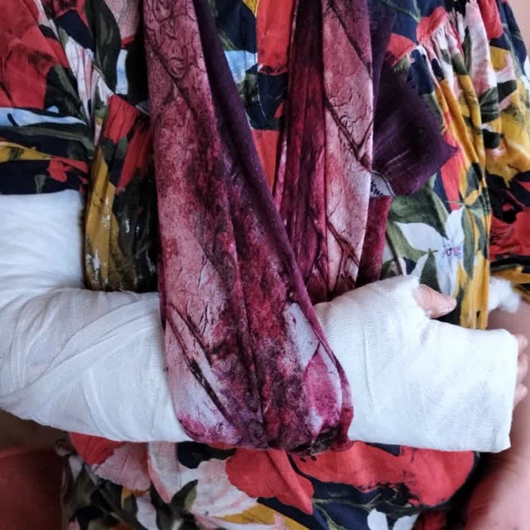 Hatalı Sargı Ve Azarlama Nedeniyle Kolda Şişlik Ve Kilitlenme