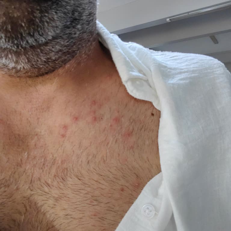 Veet Hassas Cilt Kremi Şiddetli Tahriş Yaratıyor
