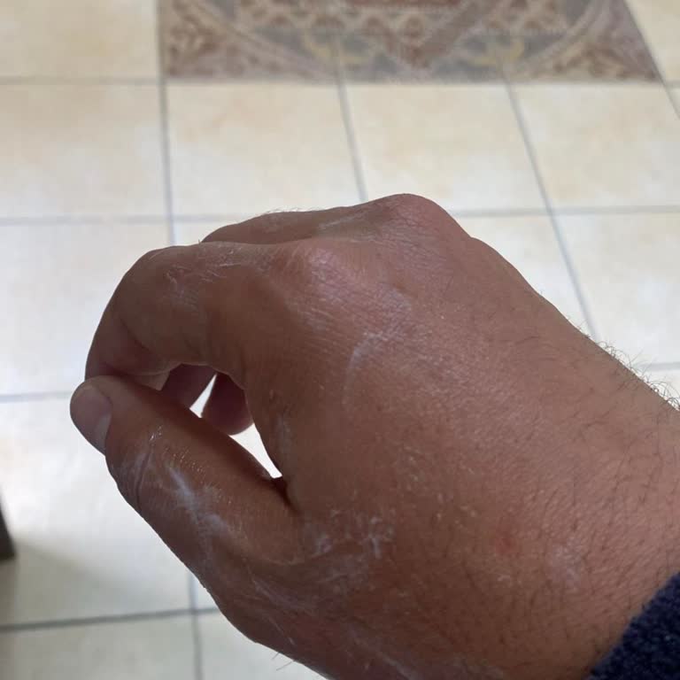 Torku Sütü Kaynamada Patladı Ve Kullanıcı Yanık Yaşadı