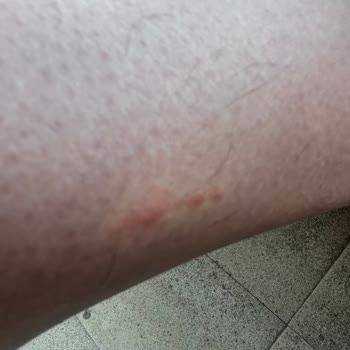 Vaat Edilen Dört Yıldızlı Otellerde Hijyen Sorunları Ve Sağlık Mağduriyeti