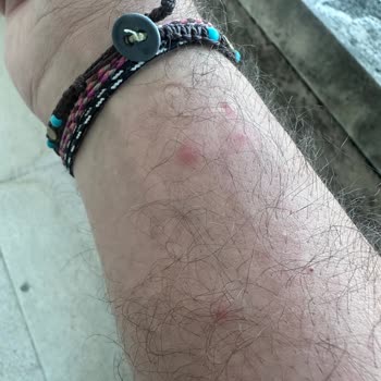 Vaat Edilen Dört Yıldızlı Otellerde Hijyen Sorunları Ve Sağlık Mağduriyeti