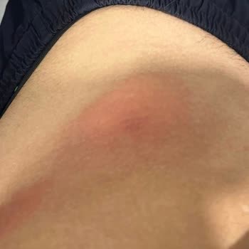 Migros'tan Aldığım OMO Deterjanı Nedeniyle Alerjik Şok Ve Acil Müdahale