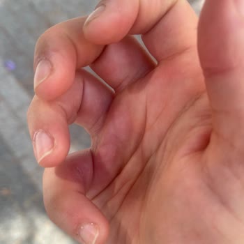 Starbucks Bardak Erimesi Nedeniyle Yanık Ve Trafik Güvenliği Şikayeti