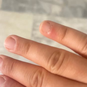 Starbucks Bardak Erimesi Nedeniyle Yanık Ve Trafik Güvenliği Şikayeti