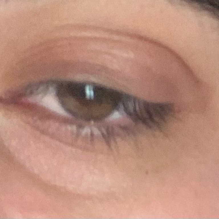 Bee Beauty Maskesi Kullanımından Şiddetli Cilt Reaksiyonu Ve Ürün İncelemesi Talebi