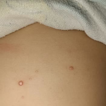 Molfix 6 Numaralı Bebek Bezinde Ciddi Sızıntı Ve Cilt Sorunları