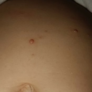 Molfix 6 Numaralı Bebek Bezinde Ciddi Sızıntı Ve Cilt Sorunları