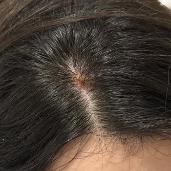 Derya Ataş Beauty Center Keratin Düzleştirme Sonrası Saç Derisi Yanıkları