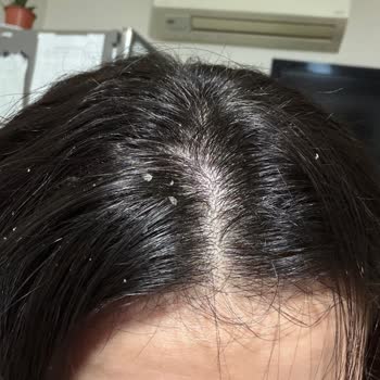 Derya Ataş Beauty Center Keratin Düzleştirme Sonrası Saç Derisi Yanıkları