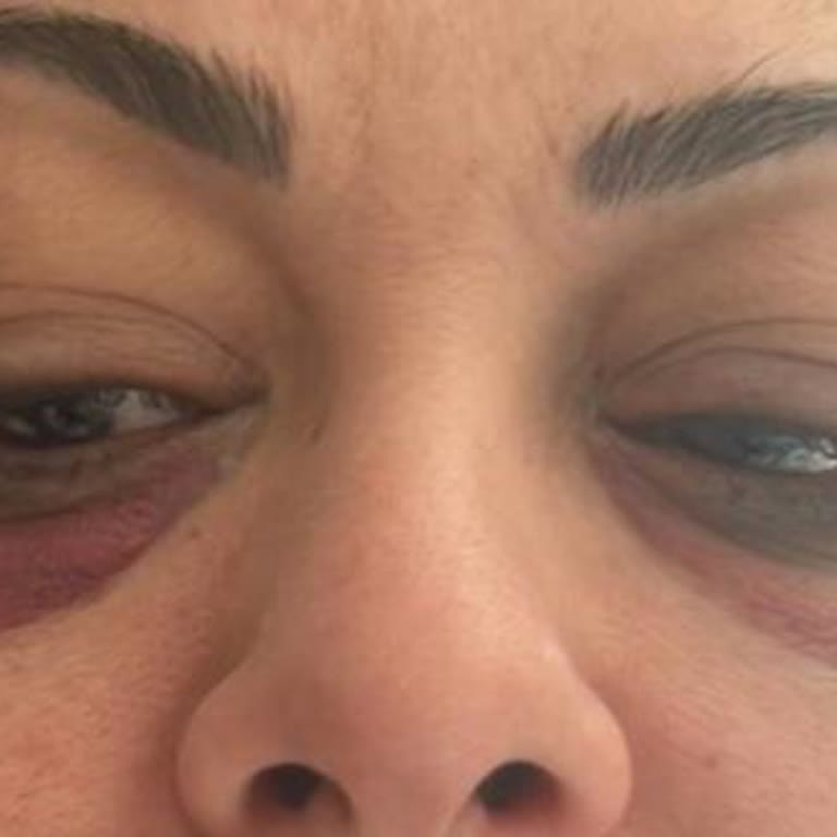 Hızlı Ve Dikkatsiz Mezoterapi İşlemi Yüzde Kalıcı Morluk Bıraktı