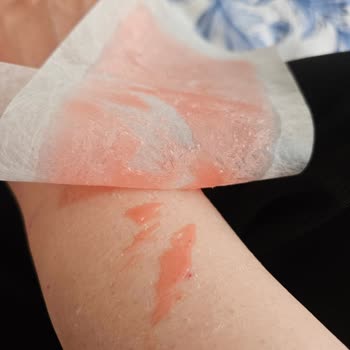Vivet Ağda Bandı Yarım Çıktı Ve Cilde Yapıştı