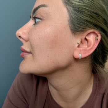 Estezey Beauty Dolgu Uygulaması Doğal Bir Görünüm Kazanmadı