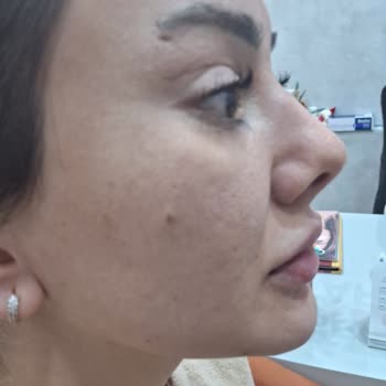 Estezey Beauty Dolgu Uygulaması Doğal Bir Görünüm Kazanmadı
