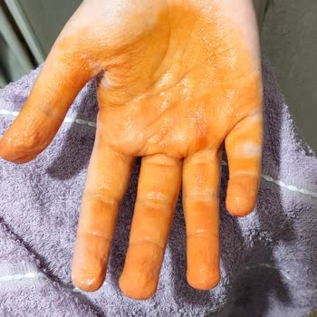 Makbul Kınası Çocuklarda Akıp Bulaştı, Sağlık Riski