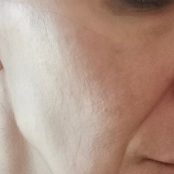 Fakir RF Facial Care Device Burned My Face on the First Use