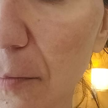 Fakir RF Facial Care Device Burned My Face on the First Use