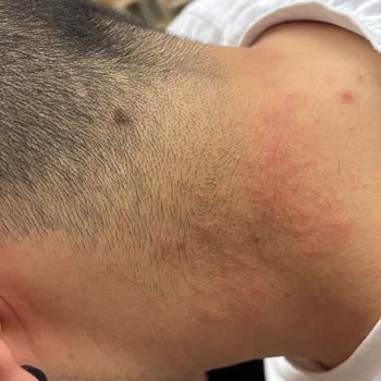 Uraw Kozmetik Mavi Saç Serumu Seti Egzama Yaptı, 90 Gün Garantisine Rağmen İade Reddedildi