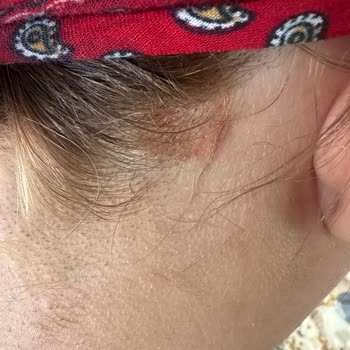 Saçlarım Koptu, Derim Yanıyor: 12 Bin TL'lik Kuaför Faciası