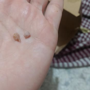 Burgerde Kemik Bulunması Ve Denetim Eksikliği