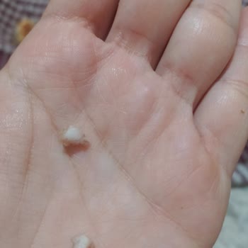 Burgerde Kemik Bulunması Ve Denetim Eksikliği