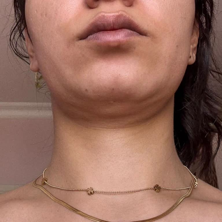 Yüzyıl Pendik Hastanesi İki Defa Başarısız Gıdı Liposuctionu Ve Yüksek Ücretli Mağduriyet