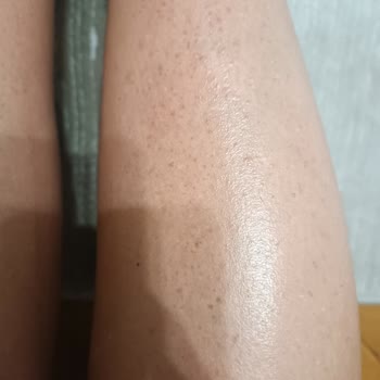 Eda Taşpınar Bronzlaştırıcı Ürünlerinde Şiddetli Alerjik Reaksiyon