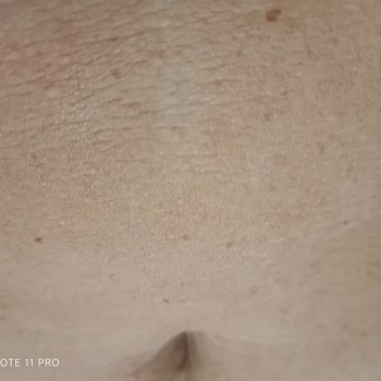 Eda Taşpınar Bronzlaştırıcı Ürünlerinde Şiddetli Alerjik Reaksiyon