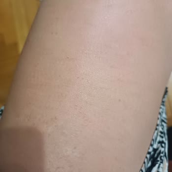Eda Taşpınar Bronzlaştırıcı Ürünlerinde Şiddetli Alerjik Reaksiyon