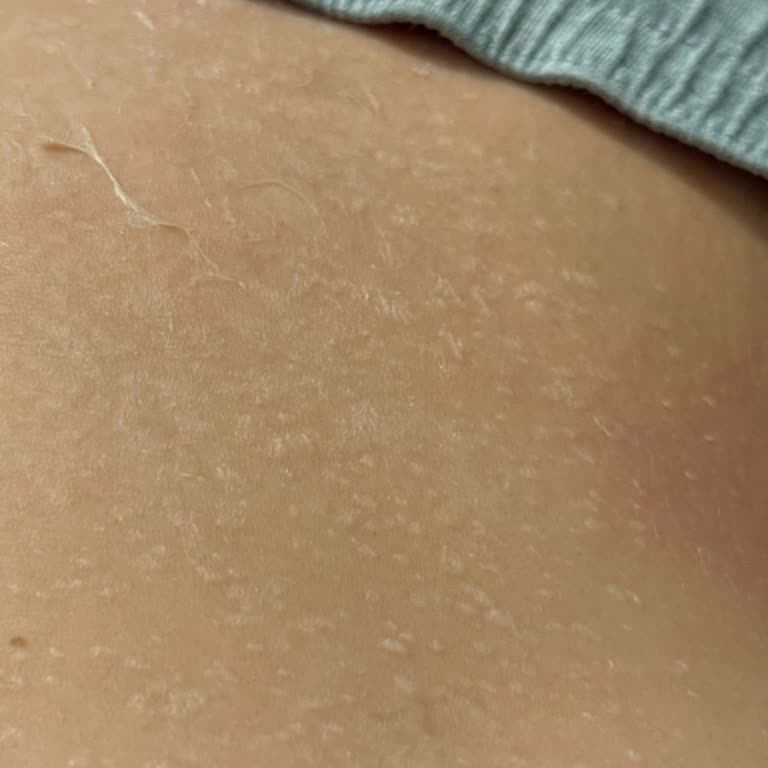 Eda Taşpınar Intense Bronzing Oil Kullanımından Ciddi İkinci Derece Yanık Ve Günlük Hayata Engel