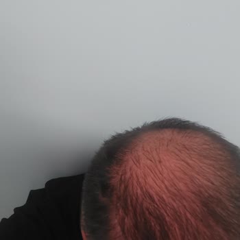 İlk Ve Revizyon Saç Ekimi Sonuçları Tatmin Etmedi, Donör Bölge Ciddi Hasar Aldı