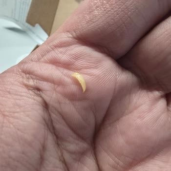 Mersin Yaprak Tantuni Şubesinde Tantuni İçinde Keskin Yabancı Cisim Ve Hijyen İhlali