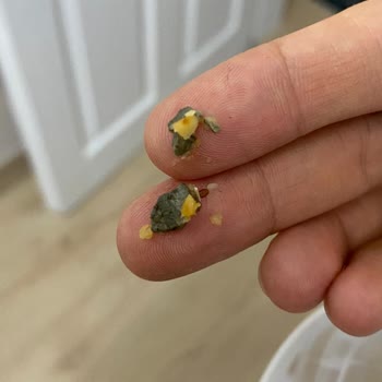 Kuru Tanem Barında Taş Çıktı, Diş Kırıldı
