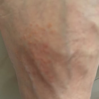 Kapalı Terlikte Tekrarlayan Alerjik Yaralar Ve Üretici Cevapsızlığı