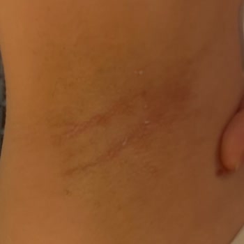 Nivea Derma Control Roll On’da Şiddetli Yanma Ve Cilt Tahrişi