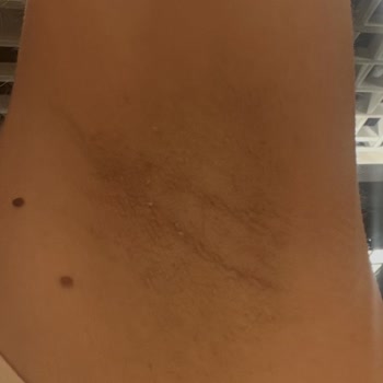 Nivea Derma Control Roll On’da Şiddetli Yanma Ve Cilt Tahrişi