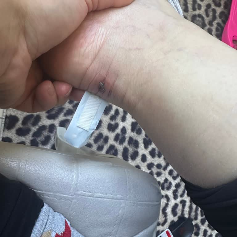 Skechers Ayakkabısının Kısa Sürede Topuk Yarası Oluşturması Ve Para İadesi Talebi