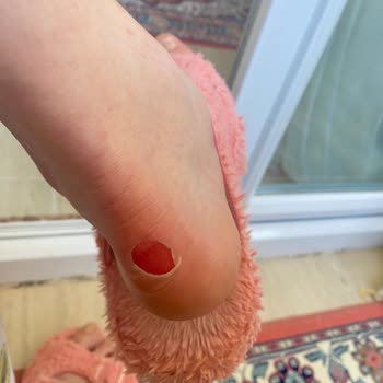Skechers Ayakkabısının İç Astar Parçalanması Ve Ücret İadesi Talebi