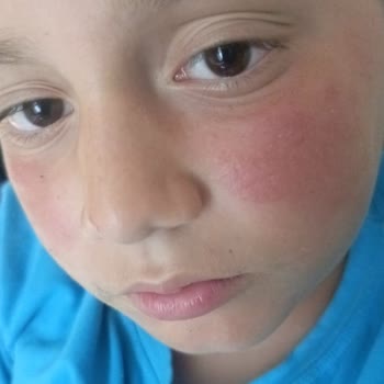 Cire Aseptine 50 Kullanımı Sonrası Çocuğumda Yanık Benzeri Cilt Tahrişi