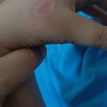 Cire Aseptine 50 Kullanımı Sonrası Çocuğumda Yanık Benzeri Cilt Tahrişi
