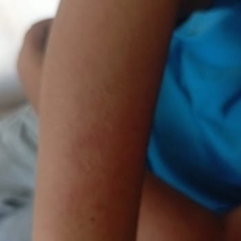 Cire Aseptine 50 Kullanımı Sonrası Çocuğumda Yanık Benzeri Cilt Tahrişi