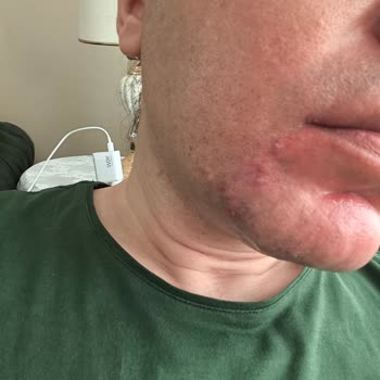 Cerave Ürünlerinden Şiddetli Cilt Alerjisi Ve Tam Ücret İadesi Talebi