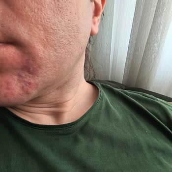 Cerave Ürünlerinden Şiddetli Cilt Alerjisi Ve Tam Ücret İadesi Talebi