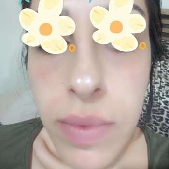 Alerjik Cilt Reaksiyonu Ve Kalitesiz Ürünler Nedeniyle Mia Klinika'dan Tam İade Talebi