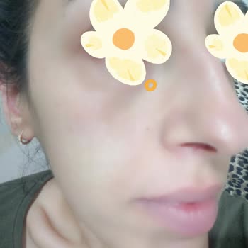 Alerjik Cilt Reaksiyonu Ve Kalitesiz Ürünler Nedeniyle Mia Klinika'dan Tam İade Talebi
