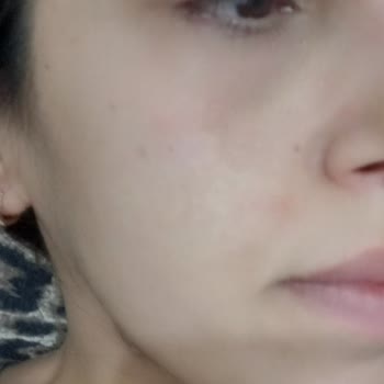 Alerjik Cilt Reaksiyonu Ve Kalitesiz Ürünler Nedeniyle Mia Klinika'dan Tam İade Talebi